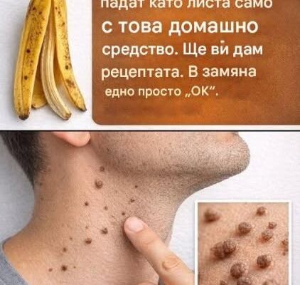Брадавиците падат като листа само с това домашно приготвено лечение. Ето рецептата. Едно просто „ОК“ е всичко, от което се нуждаете.